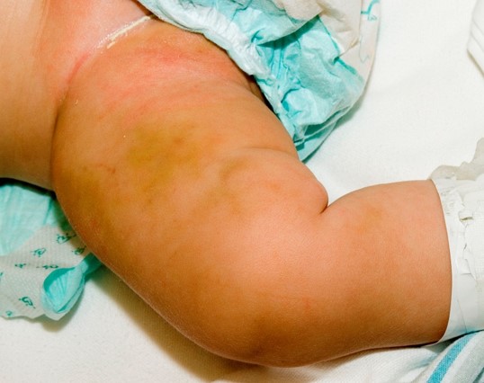 Bruises on a toddler's leg